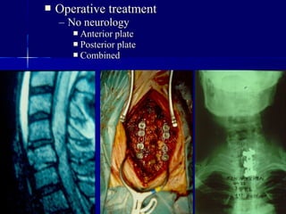  OOppeerraattiivvee ttrreeaattmmeenntt 
– NNoo nneeuurroollooggyy 
 AAnntteerriioorr ppllaattee 
 PPoosstteerriioorr ppllaattee 
 CCoommbbiinneedd 
 