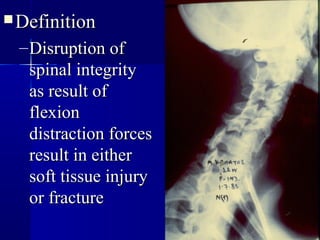 DDeeffiinniittiioonn 
–DDiissrruuppttiioonn ooff 
ssppiinnaall iinntteeggrriittyy 
aass rreessuulltt ooff 
fflleexxiioonn 
ddiissttrraaccttiioonn ffoorrcceess 
rreessuulltt iinn eeiitthheerr 
ssoofftt ttiissssuuee iinnjjuurryy 
oorr ffrraaccttuurree 
 