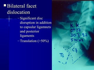 BBiillaatteerraall ffaacceett 
ddiissllooccaattiioonn 
– SSiiggnniiffiiccaanntt ddiisscc 
ddiissrruuppttiioonn iinn aaddddiittiioonn 
ttoo ccaappssuullaarr lliiggaammnneettss 
aanndd ppoosstteerriioorr 
lliiggaammeennttss 
–TTrraannssllaattiioonn ((>>5500%%)) 
 