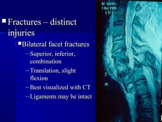  FFrraacc ttuurreess –– ddiissttiinncctt 
iinnjjuurriieess 
BBiillaatteerraall ffaacceett ffrraaccttuurreess 
– SSuuppeerriioorr,, iinnffeerriioorr,, 
ccoommbbiinnaattiioonn 
–TTrraannssllaattiioonn,, sslliigghhtt 
fflleexxiioonn 
–BBeesstt vviissuuaalliizzeedd wwiitthh CCTT 
–LLiiggaammeennttss mmaayy bbee iinnttaacctt 
 