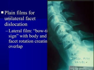  PPllaaiinn ffiillmmss ffoorr 
uunniillaatteerraall ffaacceett 
ddiissllooccaattiioonn 
–LLaatteerraall ffiillmm:: ““bbooww--ttiiee 
ssiiggnn”” wwiitthh bbooddyy aanndd 
ffaacceett rroottaattiioonn ccrreeaattiinngg 
oovveerrllaapp 
 