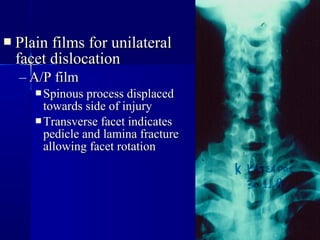  PPllaaiinn ffiillmmss ffoorr uunniillaatteerraall 
ffaacceett ddiissllooccaattiioonn 
– AA//PP ffiillmm 
SSppiinnoouuss pprroocceessss ddiissppllaacceedd 
ttoowwaarrddss ssiiddee ooff iinnjjuurryy 
TTrraannssvveerrssee ffaacceett iinnddiiccaatteess 
ppeeddiiccllee aanndd llaammiinnaa ffrraaccttuurree 
aalllloowwiinngg ffaacceett rroottaattiioonn 
 
