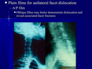  Plain films ffoorr uunniillaatteerraall ffaacceett ddiissllooccaattiioonn 
– AA//PP ffiillmm 
 OObblliiqquuee ffiillmmss mmaayy bbeetttteerr ddeemmoonnssttrraattee ddiissllooccaattiioonn aanndd 
rreevveeaall aassssoocciiaatteedd ffaacceett ffrraaccttuurreess 
 