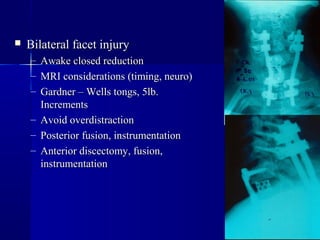  BBiillaatteerraall ffaacceett iinnjjuurryy 
– AAwwaakkee cclloosseedd rreedduuccttiioonn 
– MMRRII ccoonnssiiddeerraattiioonnss ((ttiimmiinngg,, nneeuurroo)) 
– GGaarrddnneerr –– WWeellllss ttoonnggss,, 55llbb.. 
IInnccrreemmeennttss 
– AAvvooiidd oovveerrddiissttrraaccttiioonn 
– PPoosstteerriioorr ffuussiioonn,, iinnssttrruummeennttaattiioonn 
– AAnntteerriioorr ddiisscceeccttoommyy,, ffuussiioonn,, 
iinnssttrruummeennttaattiioonn 
 