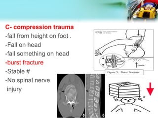 C- compression trauma
-fall from height on foot .
-Fall on head
-fall something on head
-burst fracture
-Stable #
-No spinal nerve
injury
 