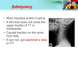 Adequacy
• Must visualize entire C-spine
• A film that does not show the
upper border of T1 is
inadequate
• Caudal traction on the arms
may help
• If can not, get swimmer’s view
or CT
 