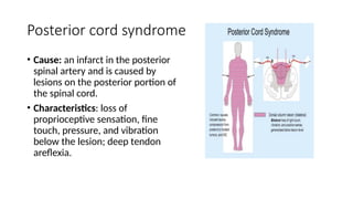 Posterior cord syndrome
• Cause: an infarct in the posterior
spinal artery and is caused by
lesions on the posterior portion of
the spinal cord.
• Characteristics: loss of
proprioceptive sensation, fine
touch, pressure, and vibration
below the lesion; deep tendon
areflexia.
 