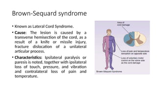 Brown-Sequard syndrome
• Known as Lateral Cord Syndrome.
• Cause: The lesion is caused by a
transverse hemisection of the cord, as a
result of a knife or missile injury,
fracture dislocation of a unilateral
articular process.
• Characteristics: Ipsilateral paralysis or
paresis is noted, together with ipsilateral
loss of touch, pressure, and vibration
and contralateral loss of pain and
temperature.
 