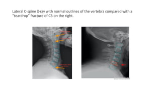 Lateral C-spine X-ray with normal outlines of the vertebra compared with a
“teardrop” fracture of C5 on the right.
 