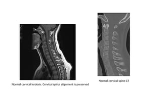 Normal cervical lordosis. Cervical spinal alignment is preserved
Normal cervical spine CT
 