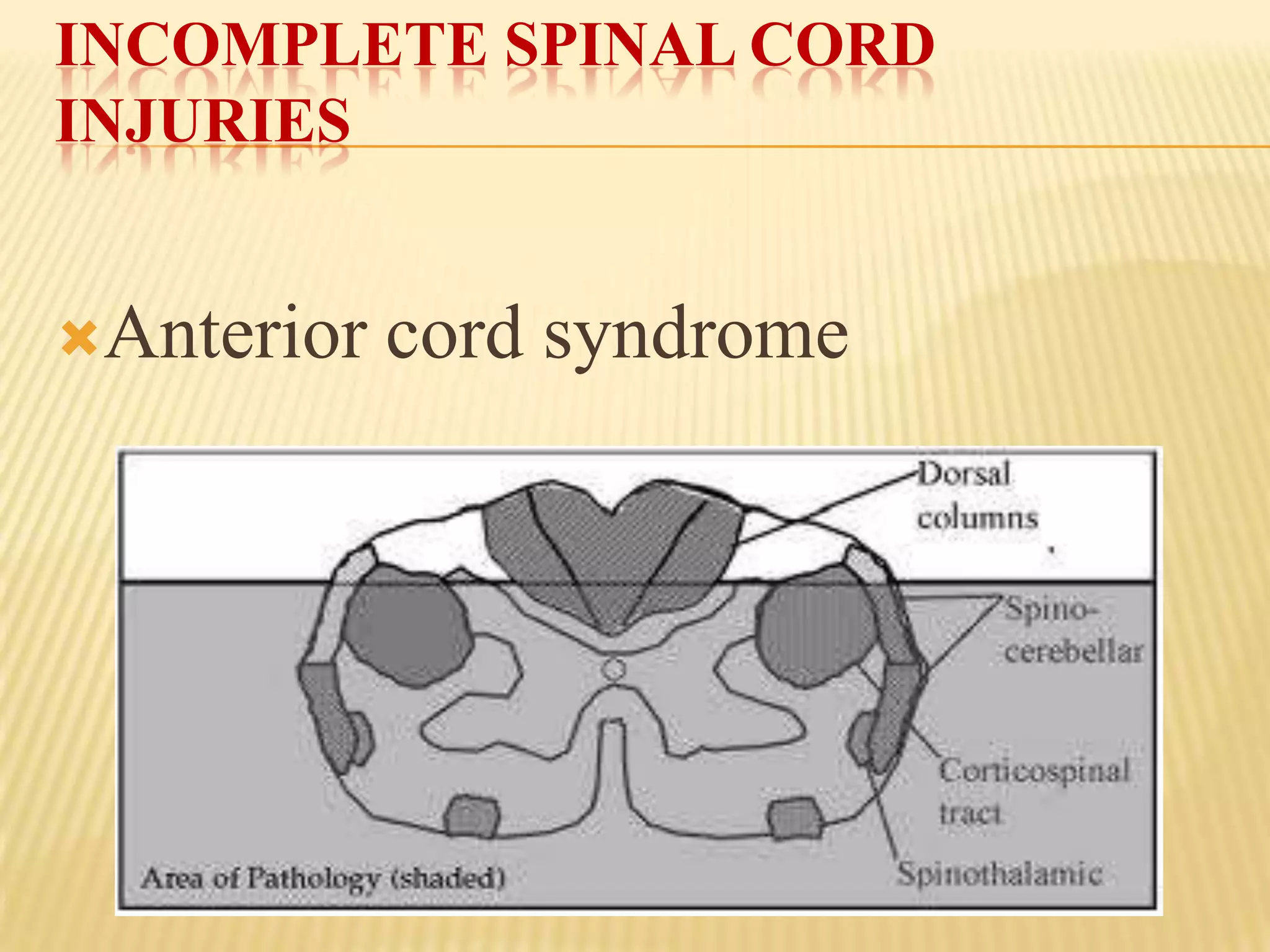 INCOMPLETE SPINAL CORD
INJURIES


Anterior   cord syndrome
 