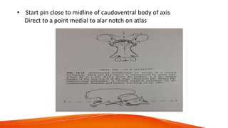 • Start pin close to midline of caudoventral body of axis
Direct to a point medial to alar notch on atlas
 