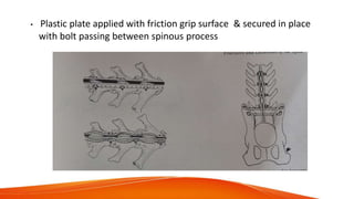 • Plastic plate applied with friction grip surface & secured in place
with bolt passing between spinous process
 
