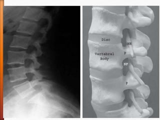 Spinal interventions for low back pain | PPTX
