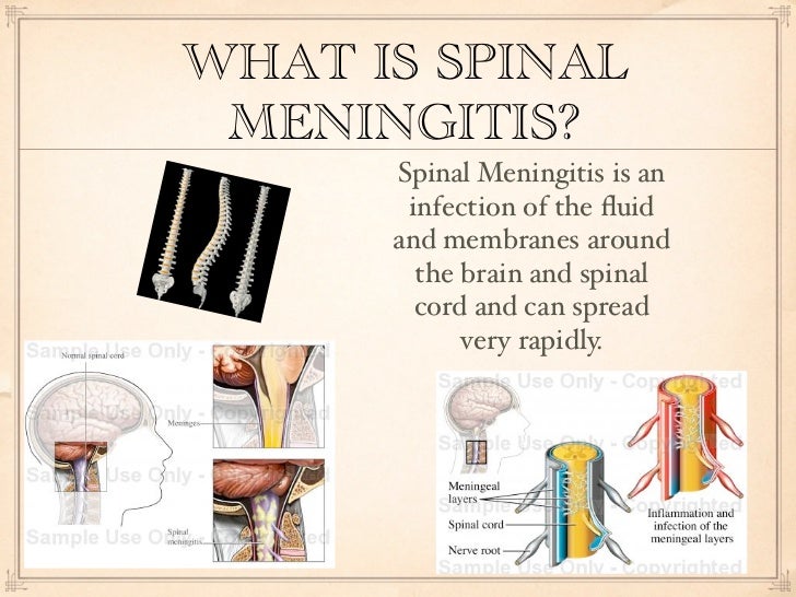 what is meningitis Meningitis or spinal meningitis is inflammation of the tissue around the brain and spinal cord discover the differences between types of meningitis. what is meningitis Meningitis or spinal meningitis is inflammation of the tissue around the brain and spinal cord discover the differences between types of meningitis.