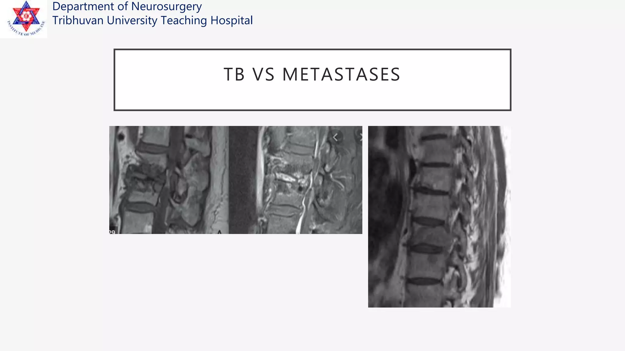 Management of Spinal Metastases | PPTX