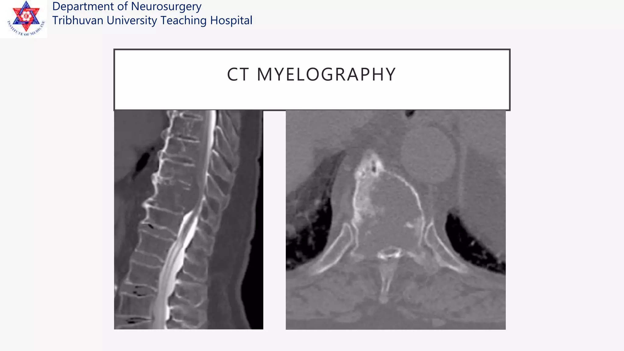 Management of Spinal Metastases | PPTX