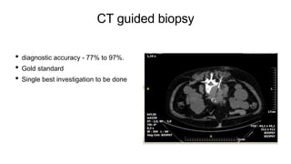 CT guided biopsy
• diagnostic accuracy - 77% to 97%.
• Gold standard
• Single best investigation to be done
 