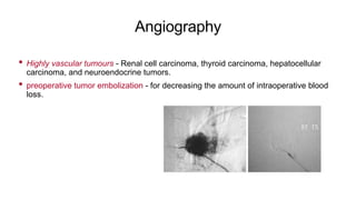 Angiography
• Highly vascular tumours - Renal cell carcinoma, thyroid carcinoma, hepatocellular
carcinoma, and neuroendocrine tumors.
• preoperative tumor embolization - for decreasing the amount of intraoperative blood
loss.
 