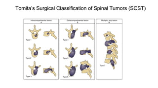 Tomita’s Surgical Classification of Spinal Tumors (SCST)
 