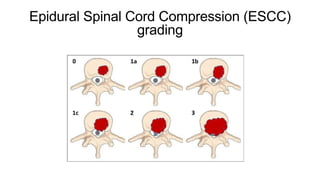 Epidural Spinal Cord Compression (ESCC)
grading
 