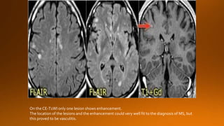 On the CE-T1WI only one lesion shows enhancement.
The location of the lesions and the enhancement could very well fit to the diagnosis of MS, but
this proved to be vasculitis.
 