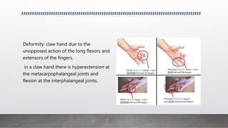 Deformity: claw hand due to the
unopposed action of the long flexors and
extensors of the fingers.
in a claw hand there is hyperextension at
the metacarpophalangeal joints and
flexion at the interphalangeal joints.
 