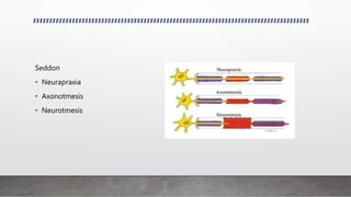 Seddon
• Neurapraxia
• Axonotmesis
• Neurotmesis
 