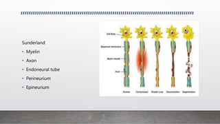 Sunderland
• Myelin
• Axon
• Endoneural tube
• Perineurium
• Epineurium
 