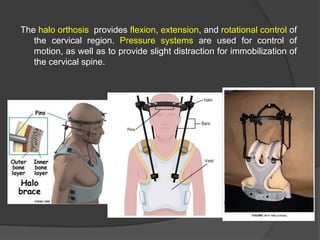 The halo orthosis provides flexion, extension, and rotational control of
the cervical region. Pressure systems are used for control of
motion, as well as to provide slight distraction for immobilization of
the cervical spine.

 