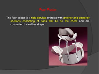 Four-Poster
The four-poster is a rigid cervical orthosis with anterior and posterior
sections consisting of pads that lie on the chest and are
connected by leather straps.

 
