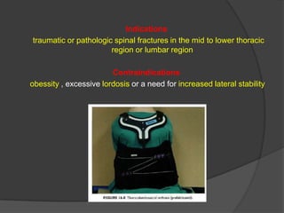 Indications
traumatic or pathologic spinal fractures in the mid to lower thoracic
region or lumbar region
Contraindications
obessity , excessive lordosis or a need for increased lateral stability

 