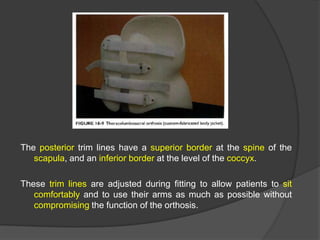The posterior trim lines have a superior border at the spine of the
scapula, and an inferior border at the level of the coccyx.
These trim lines are adjusted during fitting to allow patients to sit
comfortably and to use their arms as much as possible without
compromising the function of the orthosis.

 