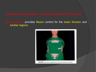 Jewett Hyperextension Thoracolumbosacral Orthosis
Biomechanics: provides flexion control for the lower thoracic and
lumbar regions

 