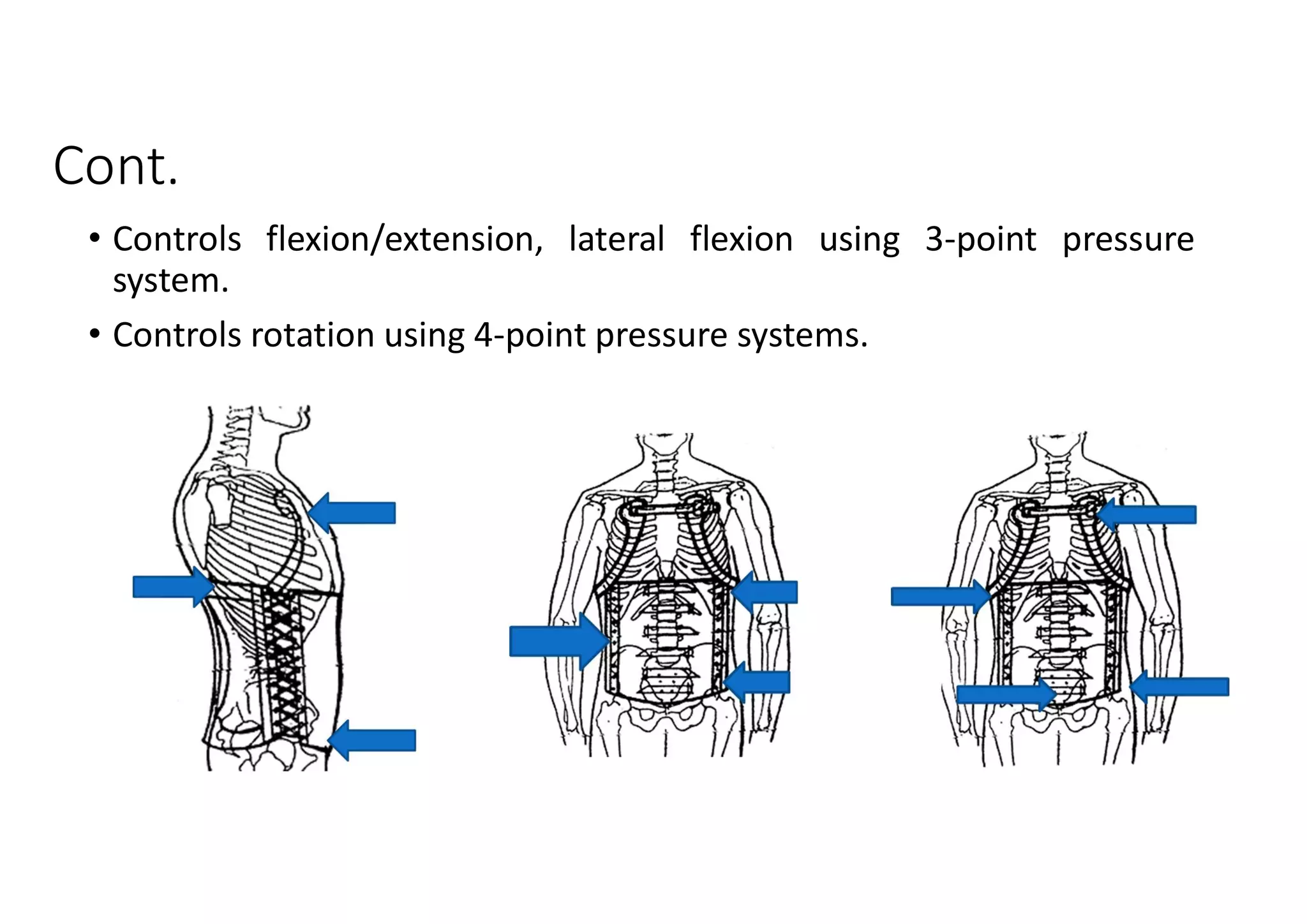 Spinal orthoses | PDF