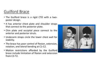 Guilford Brace
• The Guilford brace is a rigid CTO with a two-
poster design.
• It has anterior chest plate and shoulder straps
that connect to the posterior plate.
• Chin plate and occipital piece connect to the
anterior and posterior struts.
• Underarm straps circle the lower chest wall for
stability.
• The brace has poor control of flexion, extension,
rotation, and lateral bending at C1-C2.
• Motion restrictions afforded by the Guilford
brace include limitation of flexion and extension
from C3-T2.
 
