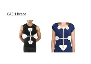 CASH Brace
 