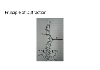 Principle of Distraction
 
