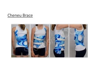 Cheneu Brace
 