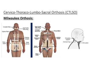 Cervico-Thoraco-Lumbo-Sacral Orthosis (CTLSO)
Milwaukee Orthosis:
 