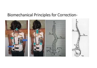Biomechanical Principles for Correction-
 