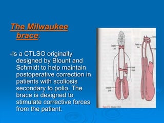 The Milwaukee
brace:
-Is a CTLSO originally
designed by Blount and
Schmidt to help maintain
postoperative correction in
patients with scoliosis
secondary to polio. The
brace is designed to
stimulate corrective forces
from the patient.
 