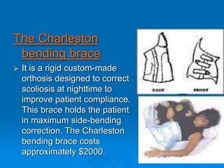 The Charleston
bending brace
 It is a rigid custom-made
orthosis designed to correct
scoliosis at nighttime to
improve patient compliance.
This brace holds the patient
in maximum side-bending
correction. The Charleston
bending brace costs
approximately $2000.
 