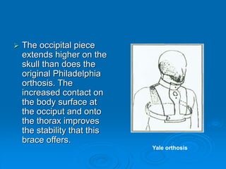  The occipital piece
extends higher on the
skull than does the
original Philadelphia
orthosis. The
increased contact on
the body surface at
the occiput and onto
the thorax improves
the stability that this
brace offers.
Yale orthosis
 
