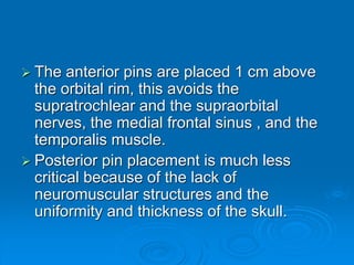  The anterior pins are placed 1 cm above
the orbital rim, this avoids the
supratrochlear and the supraorbital
nerves, the medial frontal sinus , and the
temporalis muscle.
 Posterior pin placement is much less
critical because of the lack of
neuromuscular structures and the
uniformity and thickness of the skull.
 