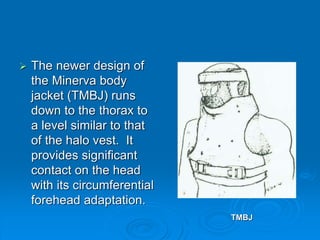  The newer design of
the Minerva body
jacket (TMBJ) runs
down to the thorax to
a level similar to that
of the halo vest. It
provides significant
contact on the head
with its circumferential
forehead adaptation.
TMBJ
 