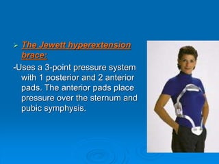  The Jewett hyperextension
brace:
-Uses a 3-point pressure system
with 1 posterior and 2 anterior
pads. The anterior pads place
pressure over the sternum and
pubic symphysis.
 