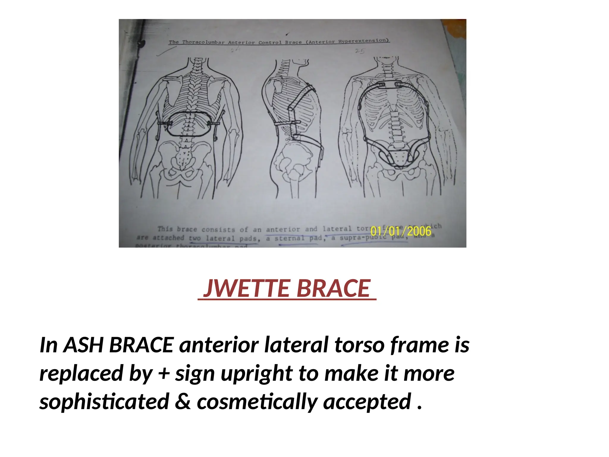 JWETTE BRACE
In ASH BRACE anterior lateral torso frame is
replaced by + sign upright to make it more
sophisticated & cosmetically accepted .
 