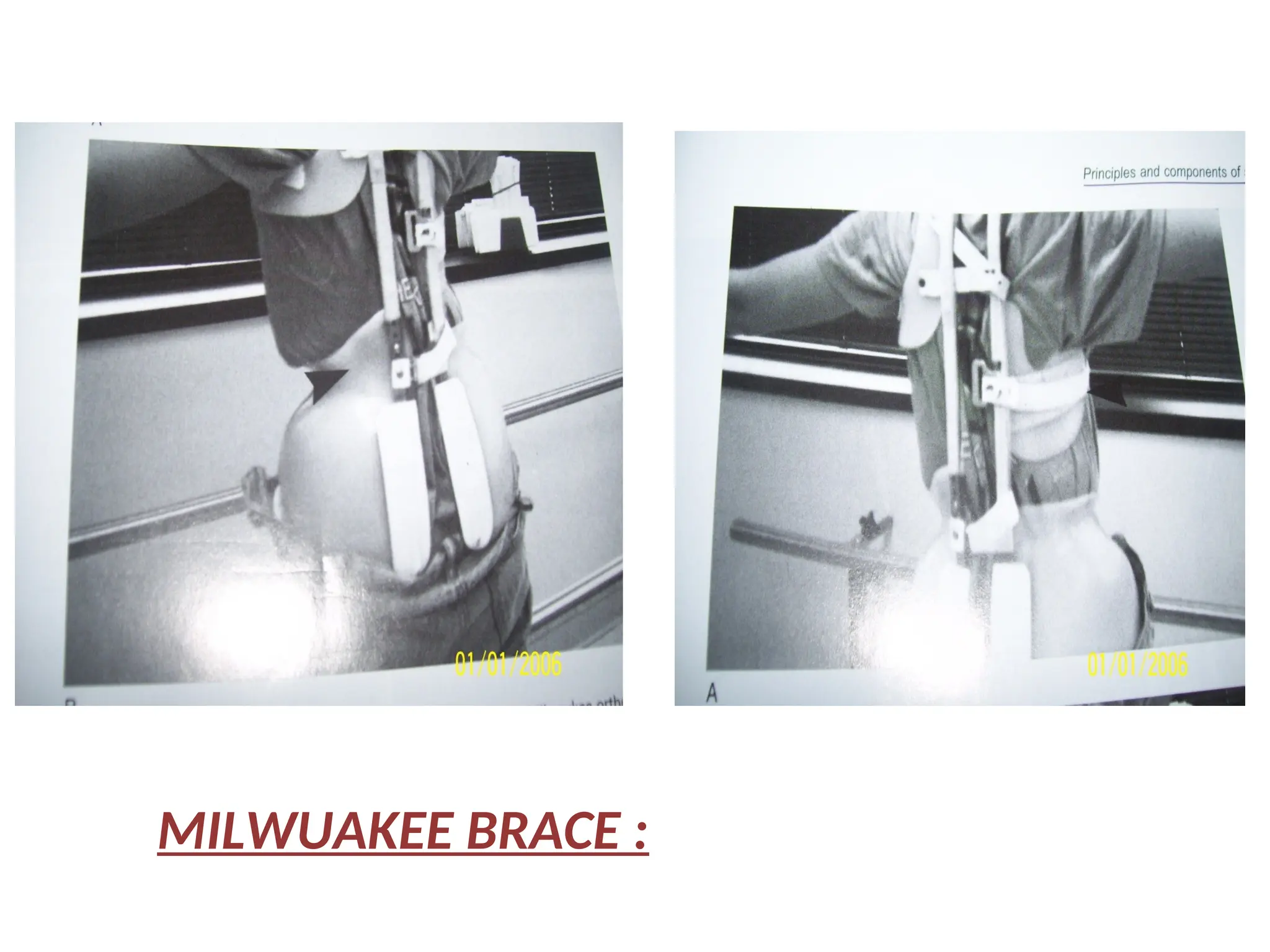 MILWUAKEE BRACE :
 