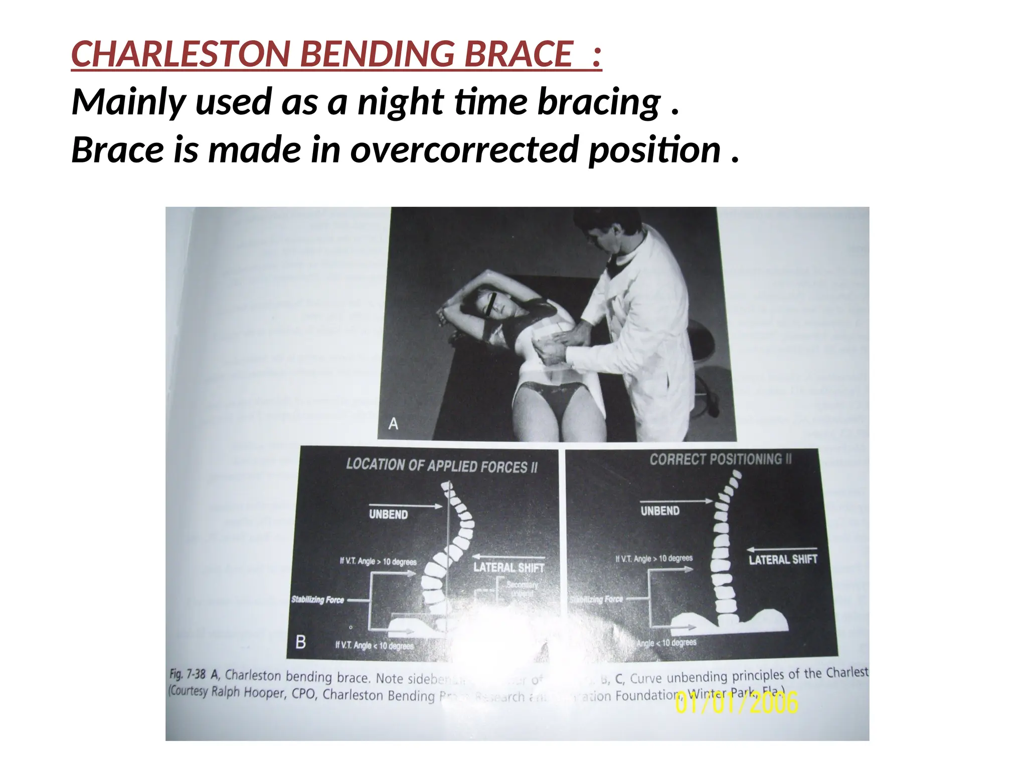 CHARLESTON BENDING BRACE :
Mainly used as a night time bracing .
Brace is made in overcorrected position .
 
